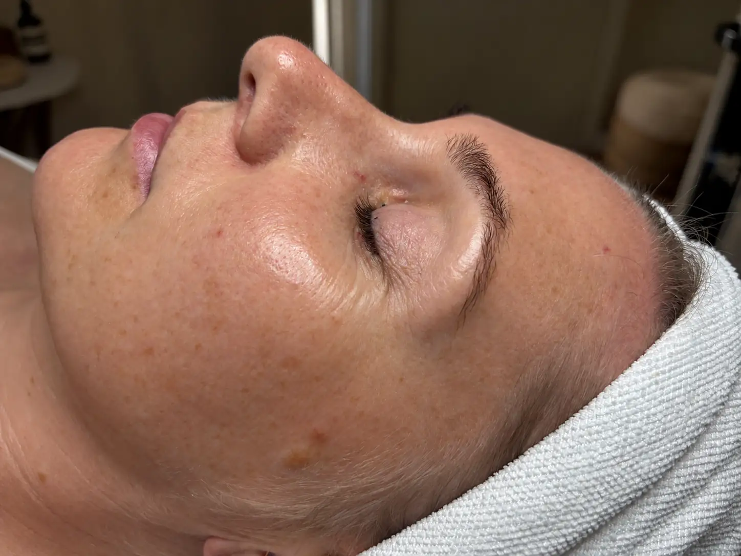 Client skin before a personalized facial treatment at Topaz Facial Studio