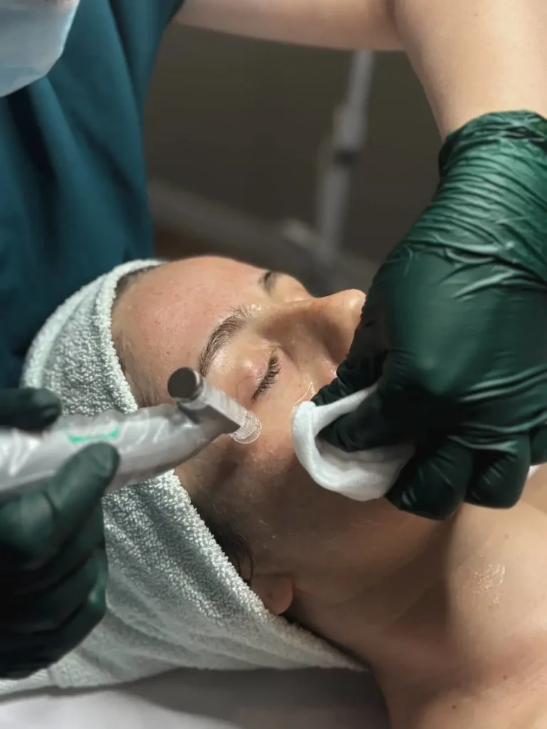 Microneedling treatment performed at Topaz Facial Studio